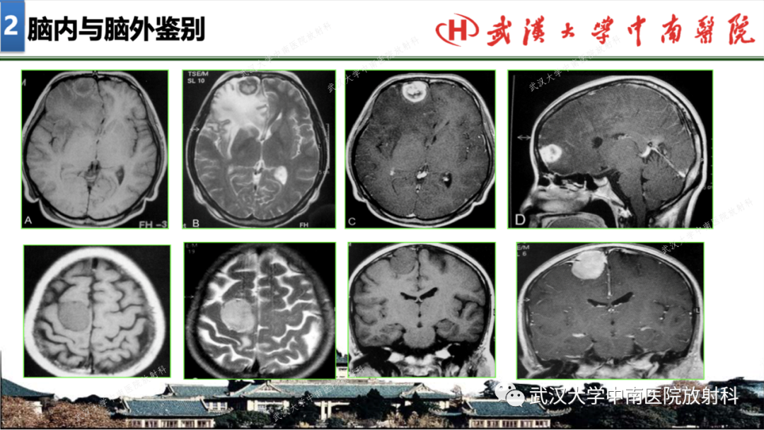 【PPT】局灶性脑部病变影像学诊断-14