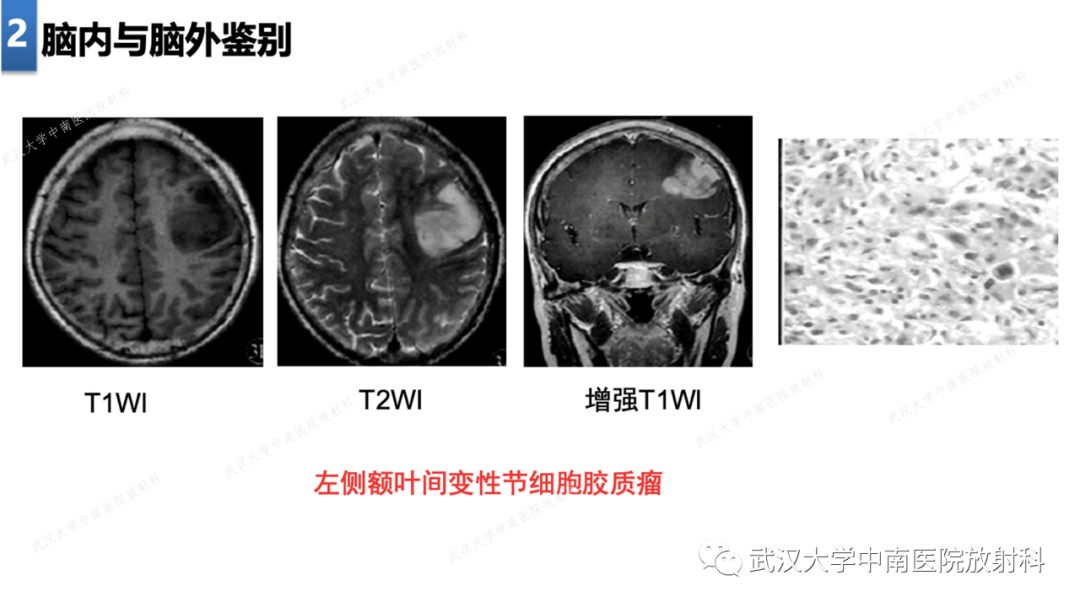 【PPT】局灶性脑部病变影像学诊断-15