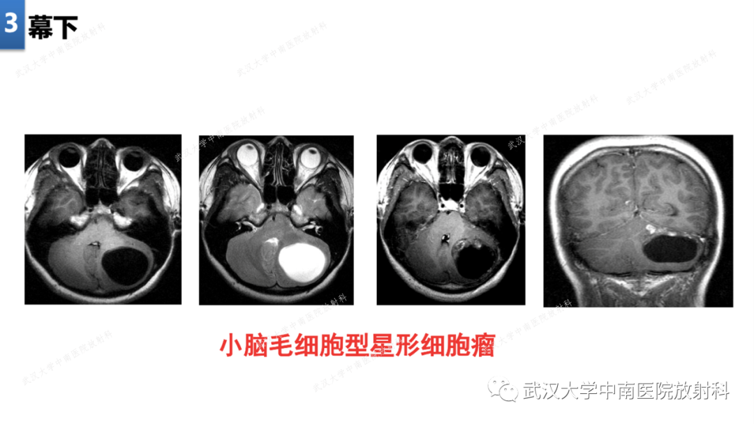 【PPT】局灶性脑部病变影像学诊断-18