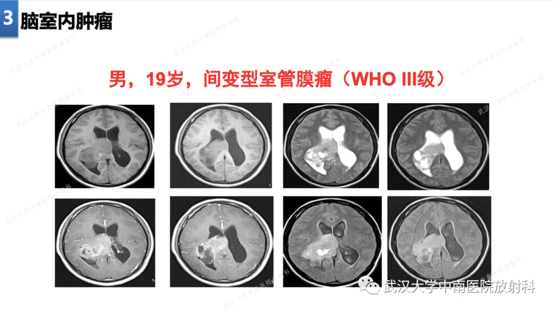 【PPT】局灶性脑部病变影像学诊断-19