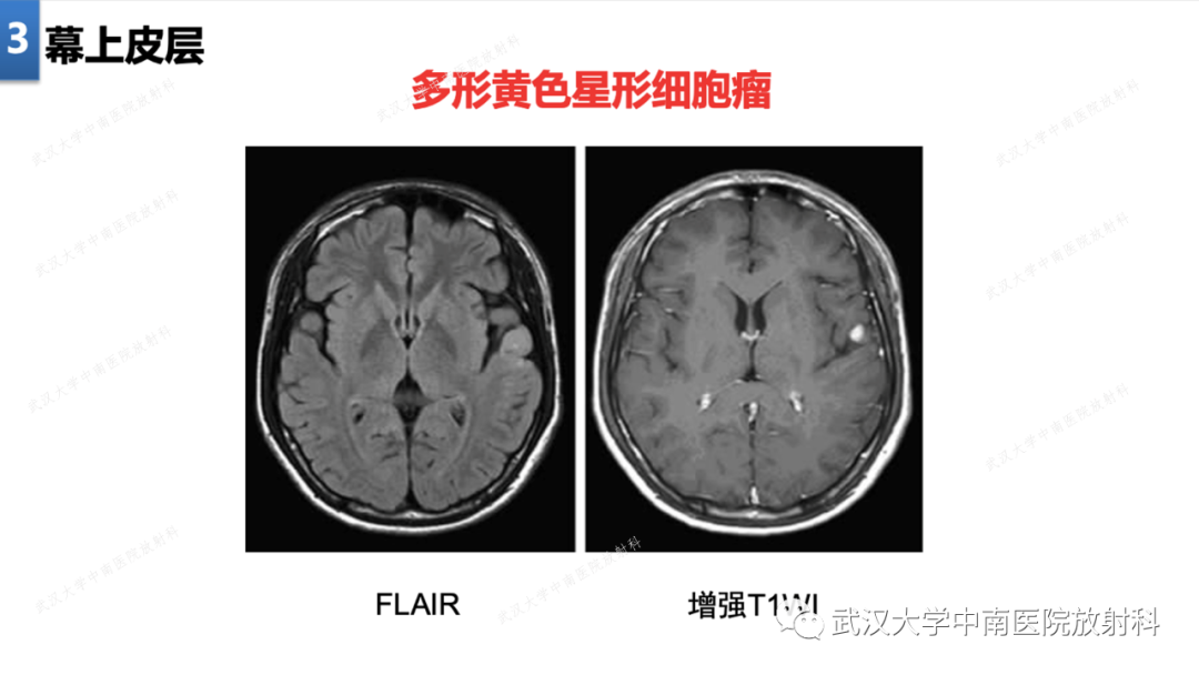 【PPT】局灶性脑部病变影像学诊断-20