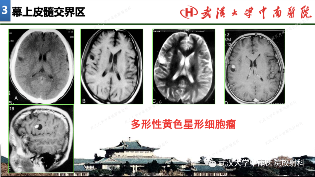 【PPT】局灶性脑部病变影像学诊断-21
