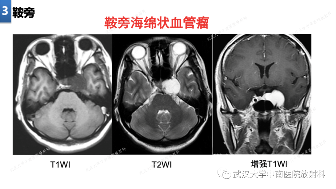 【PPT】局灶性脑部病变影像学诊断-22