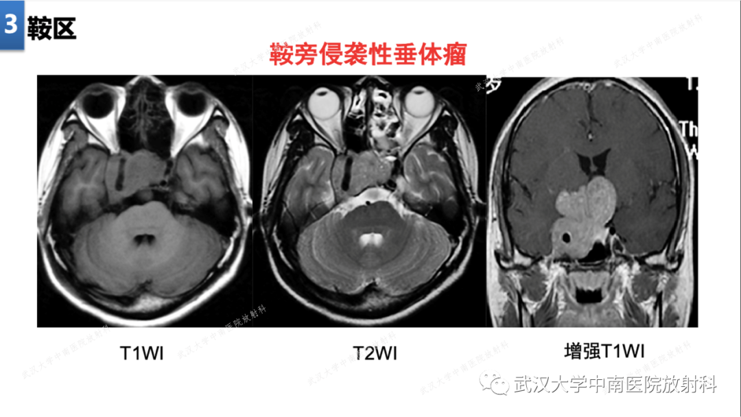【PPT】局灶性脑部病变影像学诊断-23