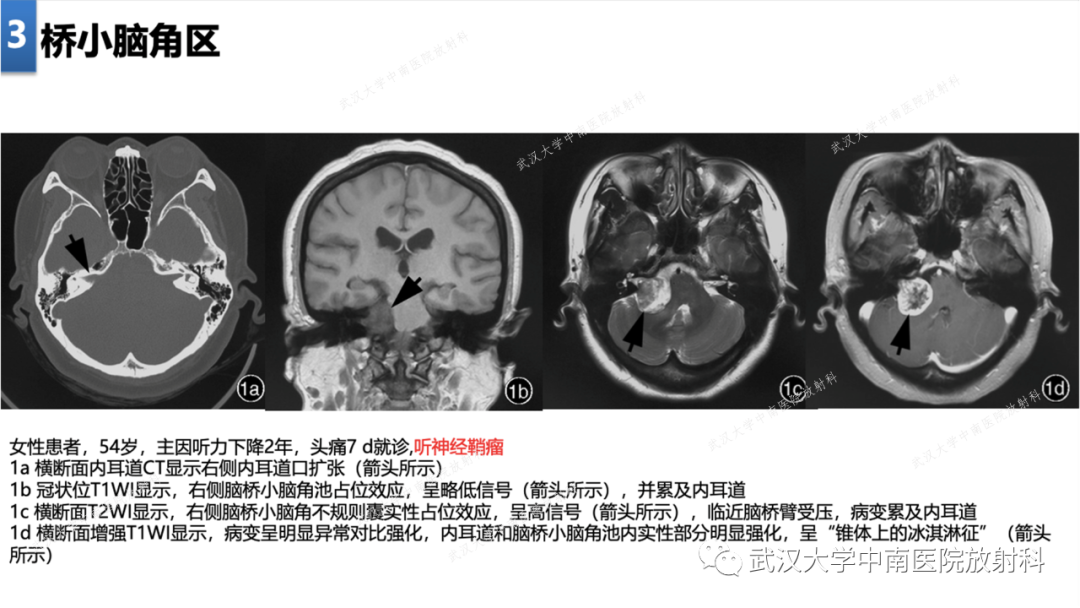 【PPT】局灶性脑部病变影像学诊断-24