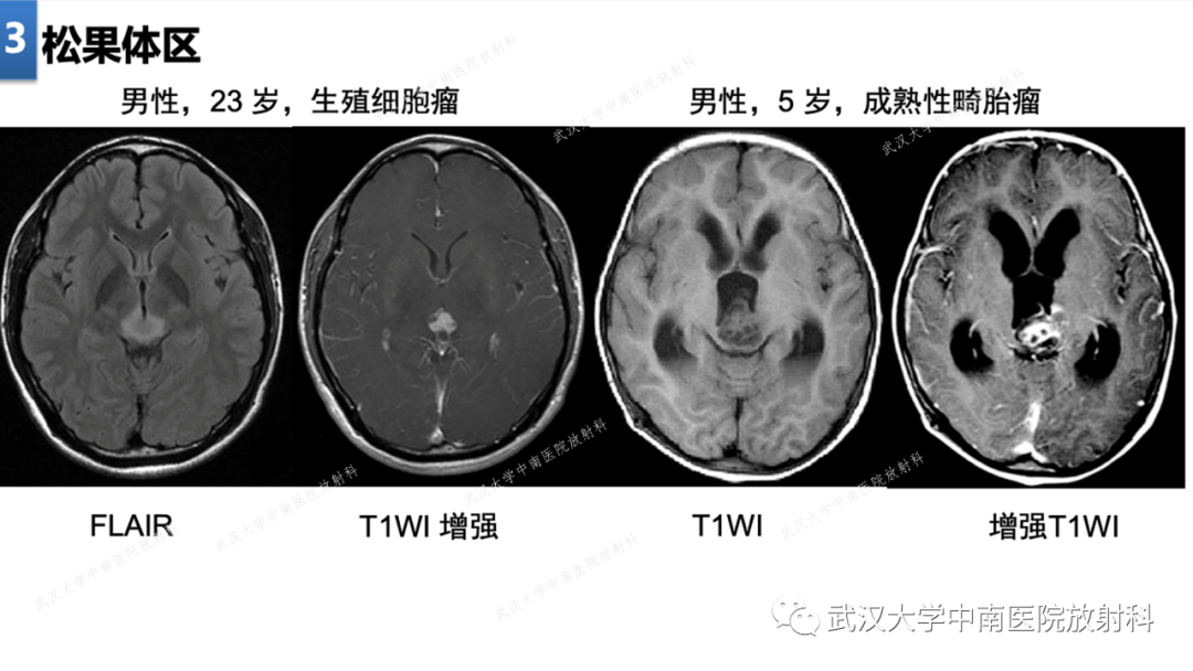 【PPT】局灶性脑部病变影像学诊断-25