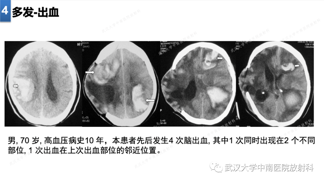 【PPT】局灶性脑部病变影像学诊断-27