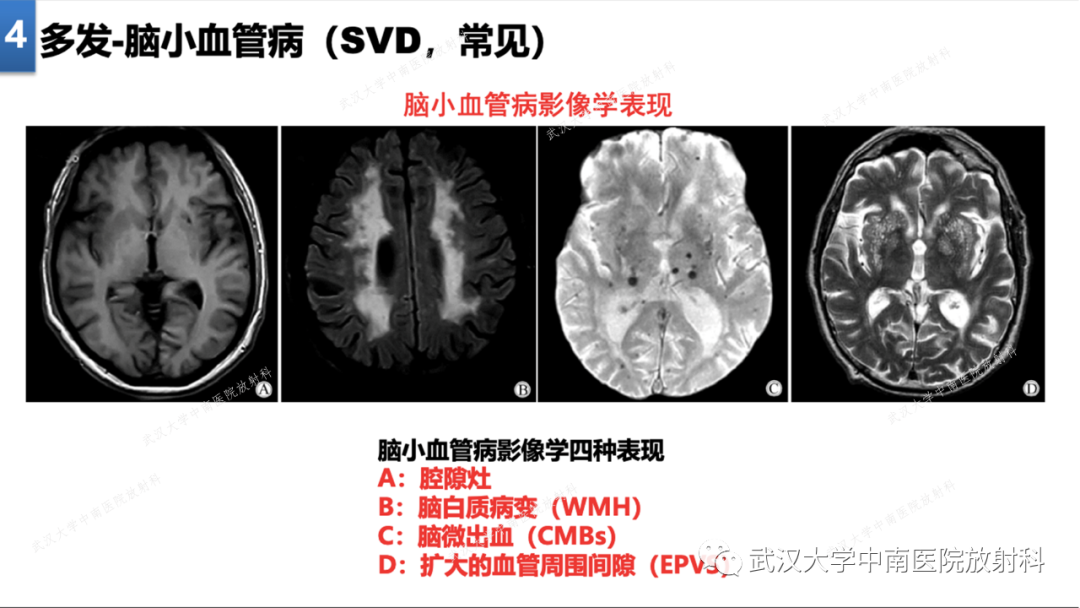 【PPT】局灶性脑部病变影像学诊断-28