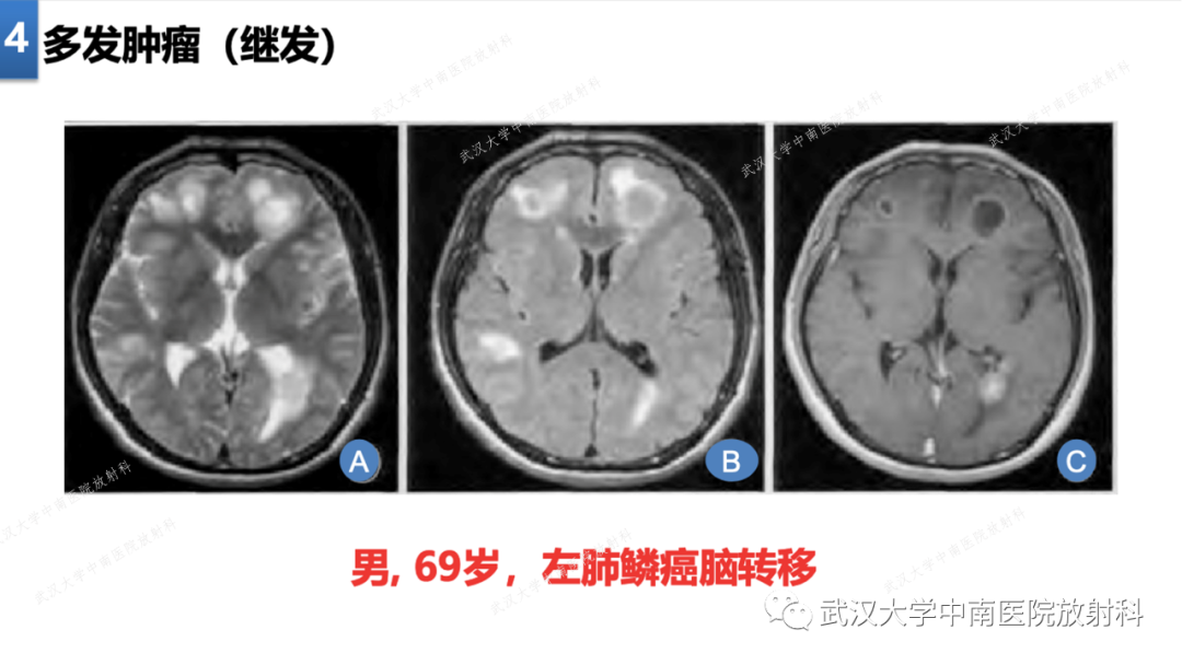【PPT】局灶性脑部病变影像学诊断-29