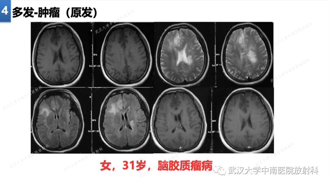 【PPT】局灶性脑部病变影像学诊断-30