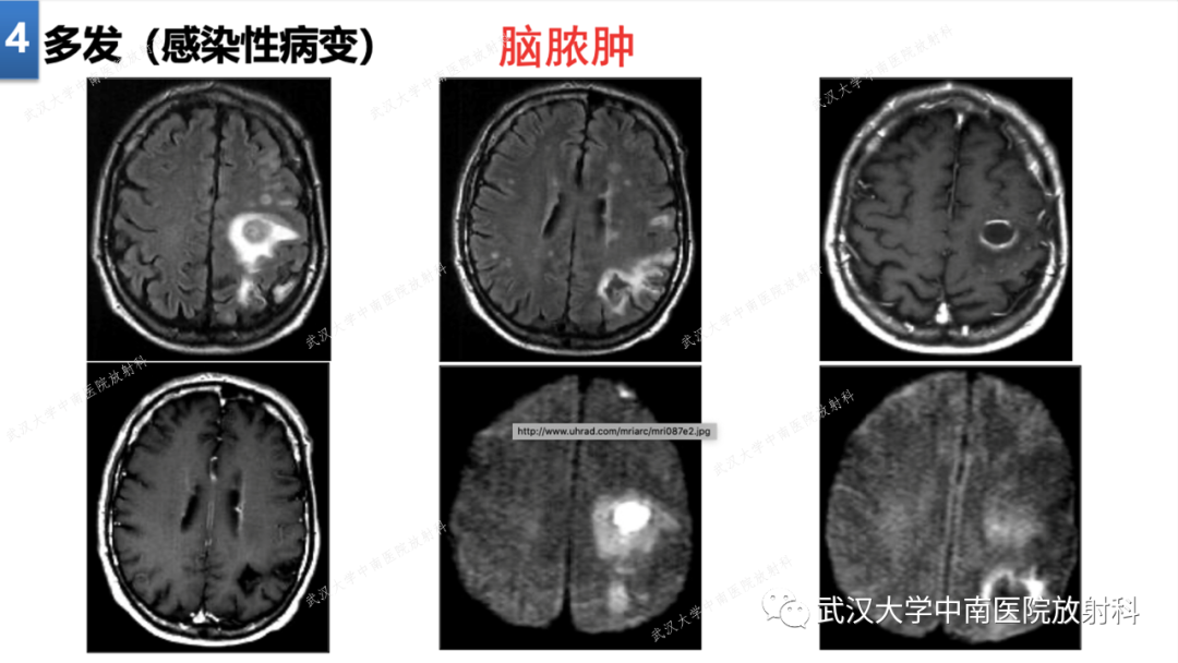【PPT】局灶性脑部病变影像学诊断-31