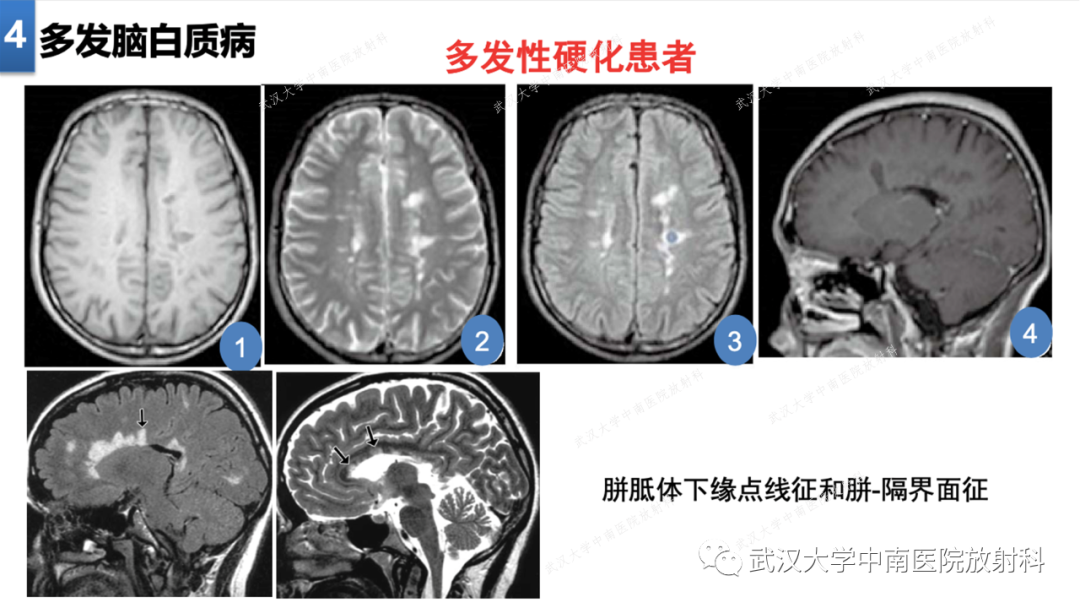 【PPT】局灶性脑部病变影像学诊断-32