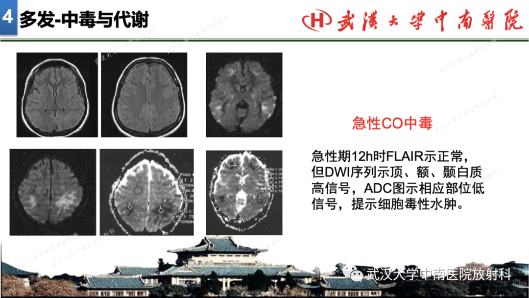 【PPT】局灶性脑部病变影像学诊断-34