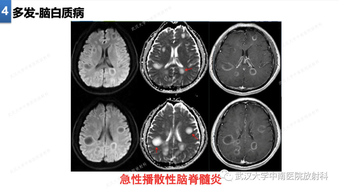 【PPT】局灶性脑部病变影像学诊断-33