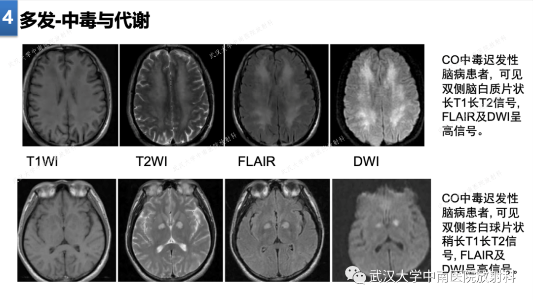 【PPT】局灶性脑部病变影像学诊断-35