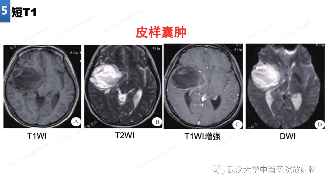 【PPT】局灶性脑部病变影像学诊断-37