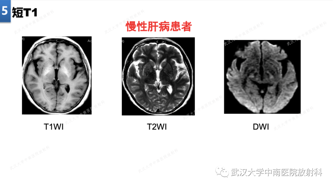【PPT】局灶性脑部病变影像学诊断-38