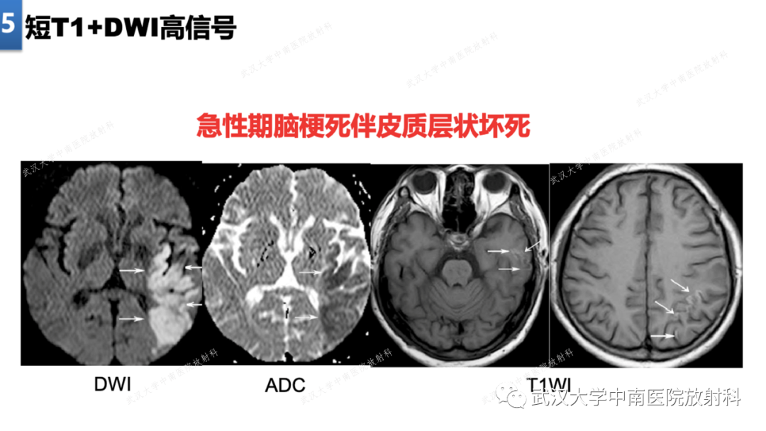 【PPT】局灶性脑部病变影像学诊断-39
