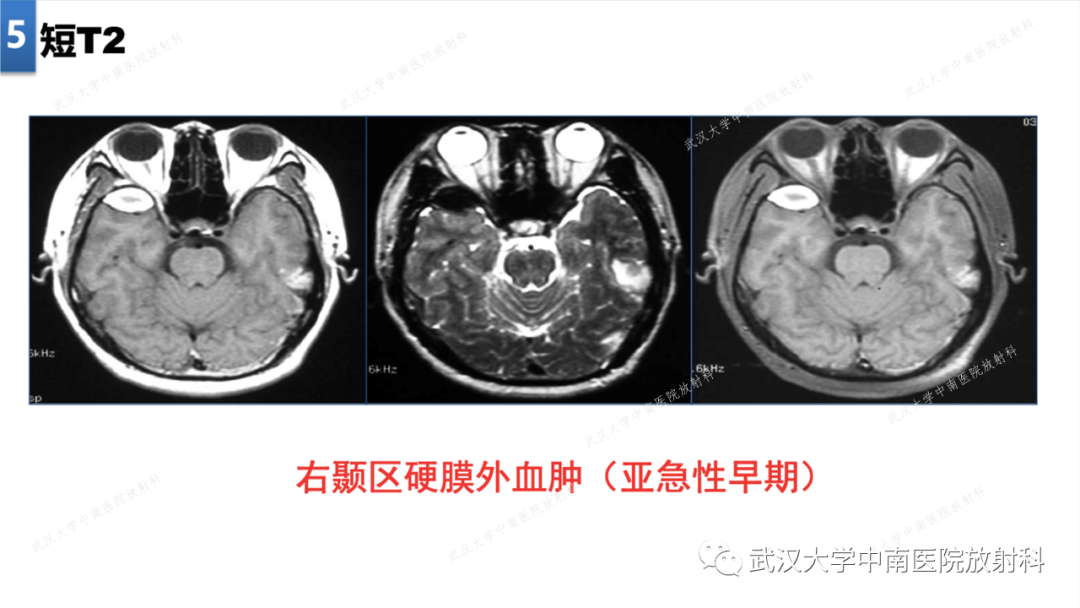 【PPT】局灶性脑部病变影像学诊断-40