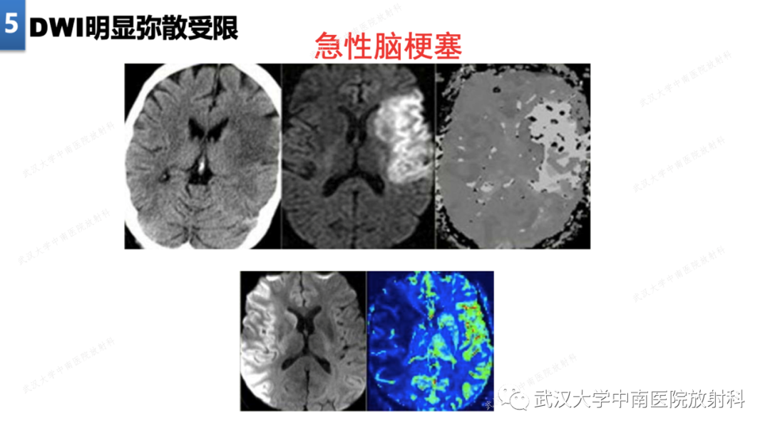 【PPT】局灶性脑部病变影像学诊断-41