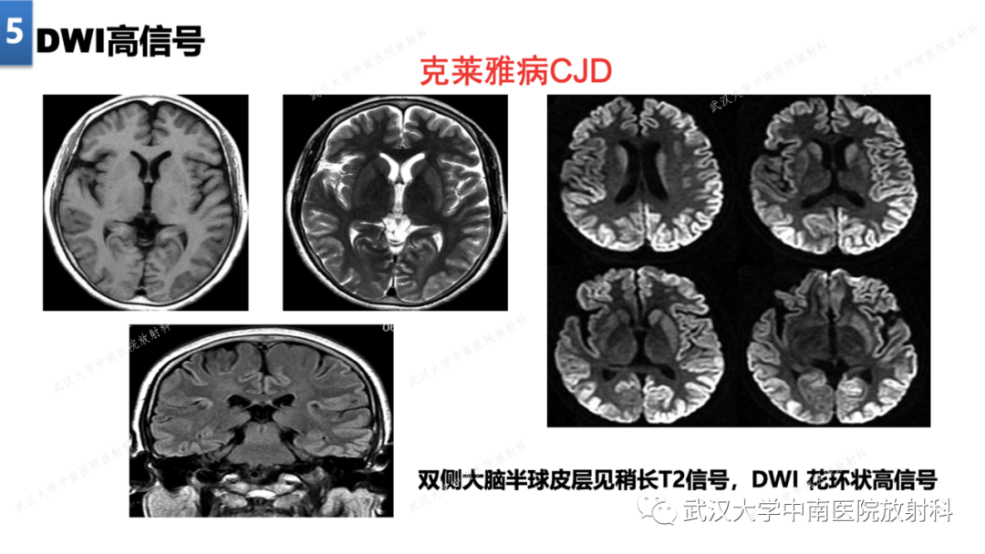 【PPT】局灶性脑部病变影像学诊断-42