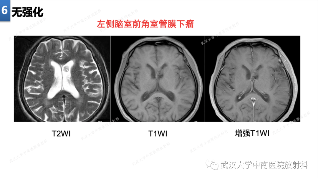 【PPT】局灶性脑部病变影像学诊断-44