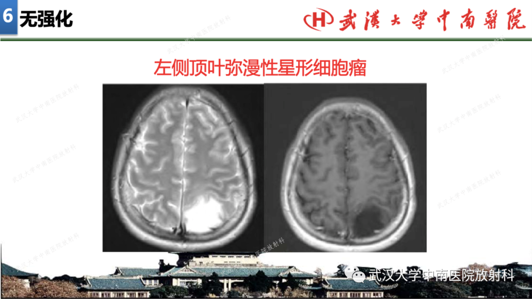 【PPT】局灶性脑部病变影像学诊断-45