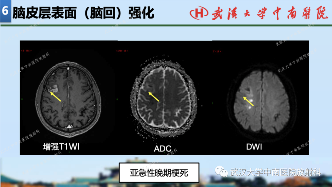 【PPT】局灶性脑部病变影像学诊断-48