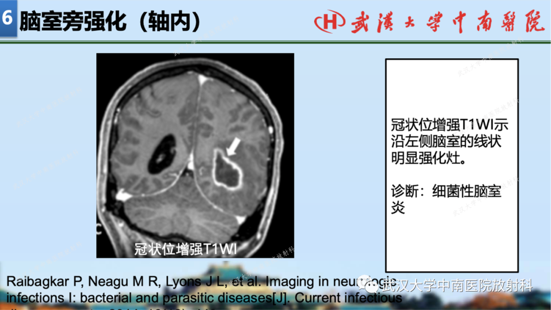 【PPT】局灶性脑部病变影像学诊断-51