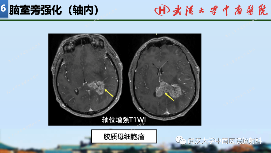 【PPT】局灶性脑部病变影像学诊断-52