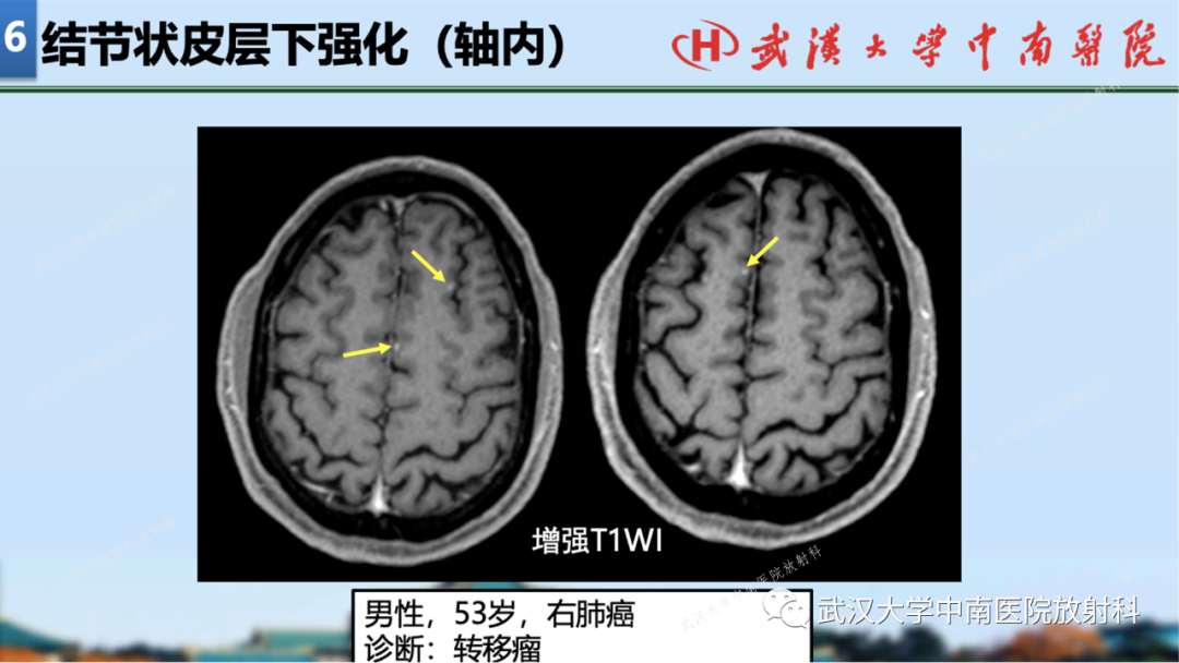 【PPT】局灶性脑部病变影像学诊断-54