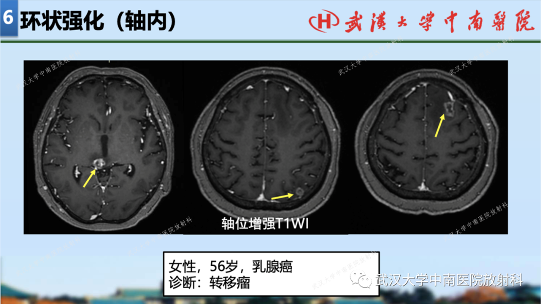 【PPT】局灶性脑部病变影像学诊断-57