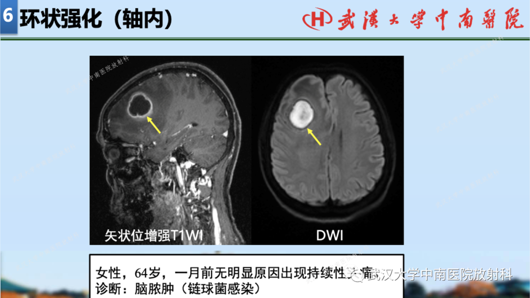 【PPT】局灶性脑部病变影像学诊断-58