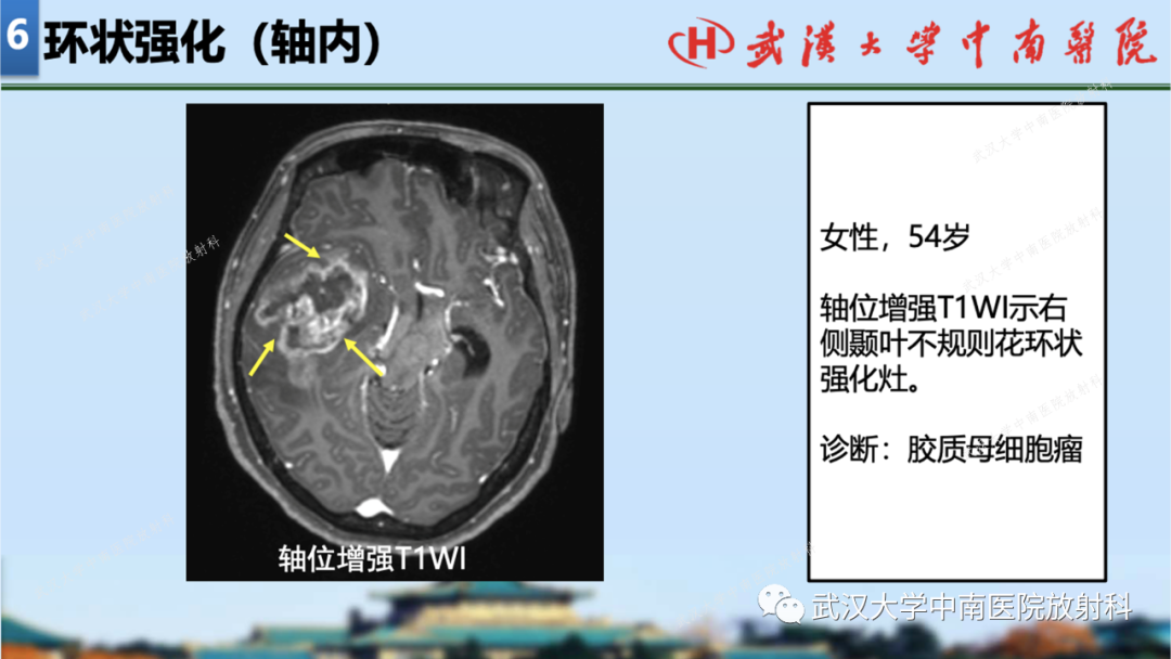 【PPT】局灶性脑部病变影像学诊断-59