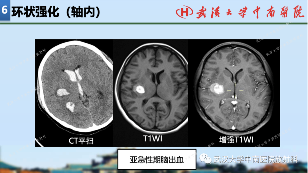 【PPT】局灶性脑部病变影像学诊断-61