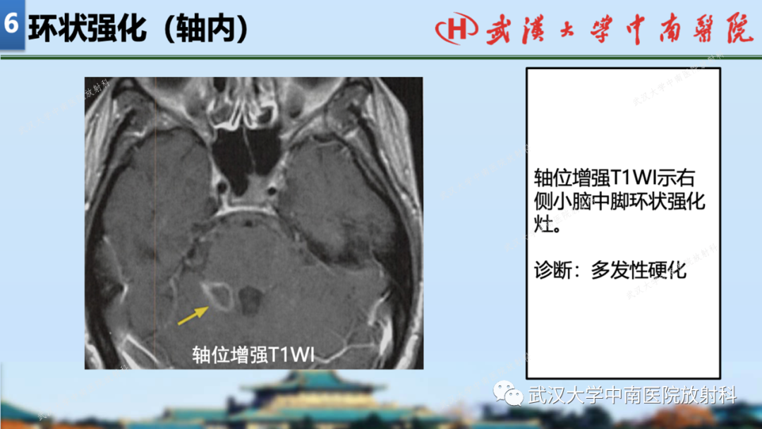 【PPT】局灶性脑部病变影像学诊断-62