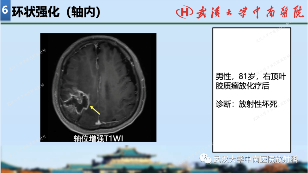 【PPT】局灶性脑部病变影像学诊断-63