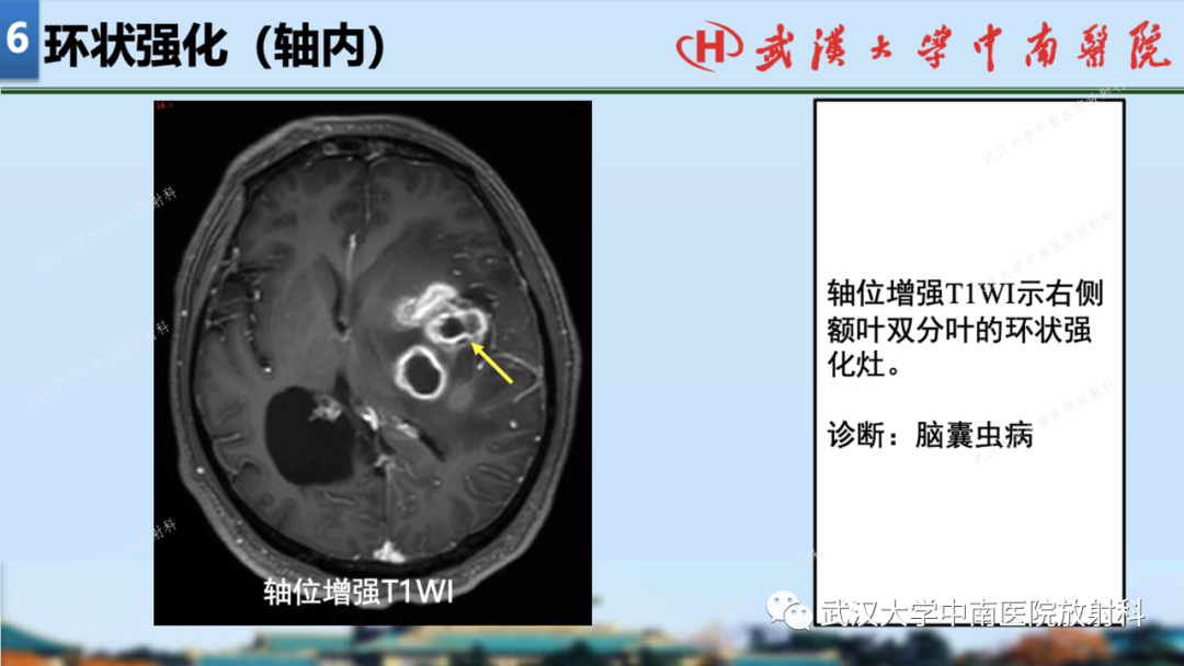 【PPT】局灶性脑部病变影像学诊断-64