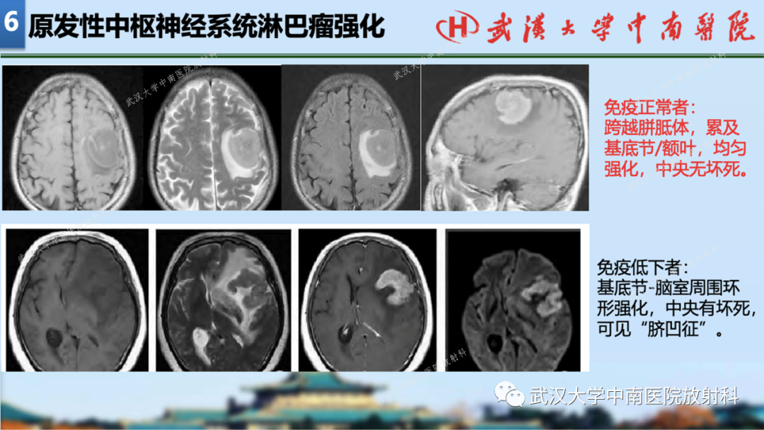 【PPT】局灶性脑部病变影像学诊断-65