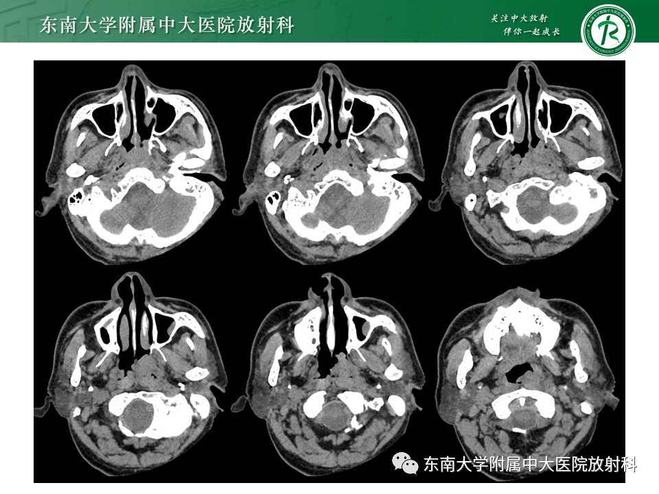 【PPT】鼻咽部占位性病变随访及鉴别-4