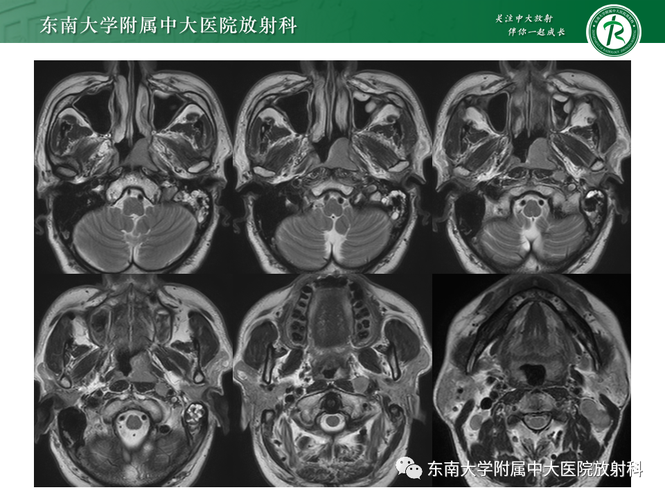 【PPT】鼻咽部占位性病变随访及鉴别-10