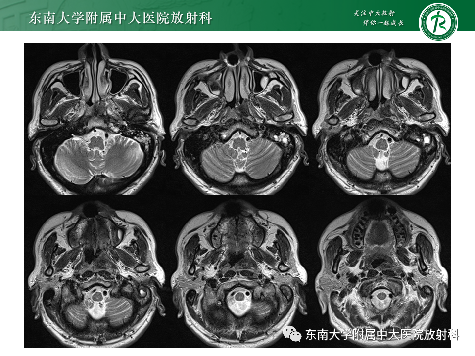 【PPT】鼻咽部占位性病变随访及鉴别-6