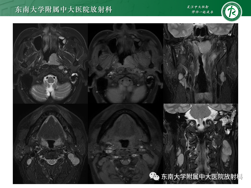 【PPT】鼻咽部占位性病变随访及鉴别-11