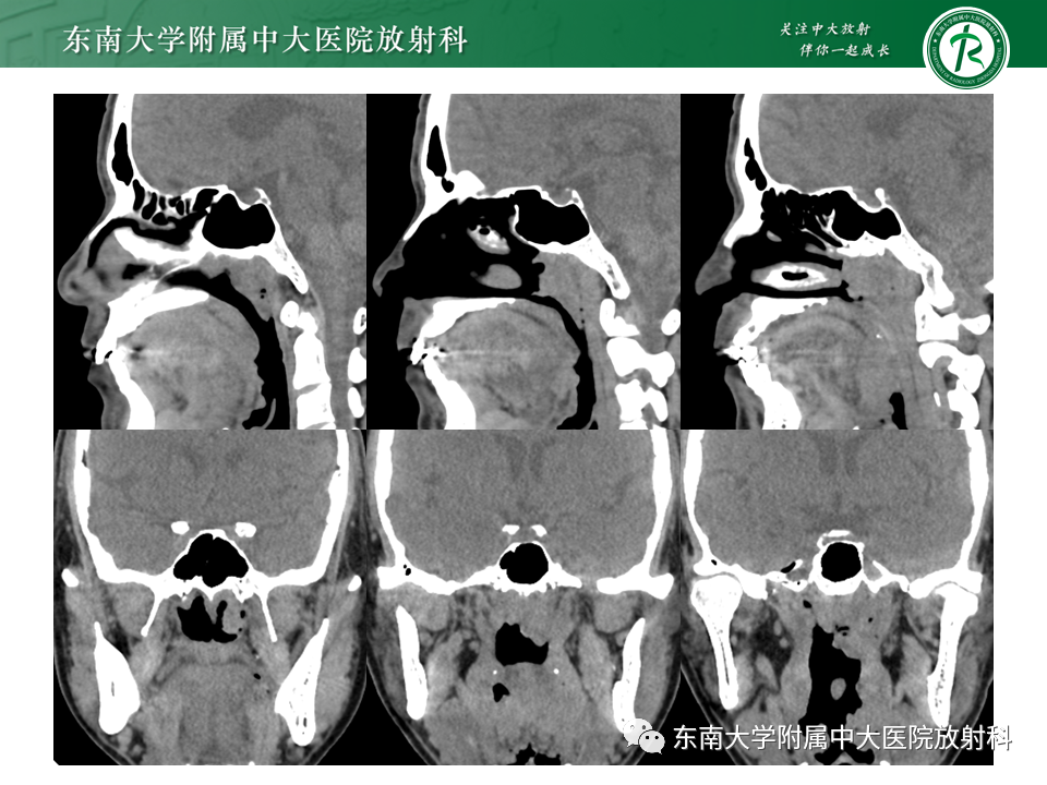 【PPT】鼻咽部占位性病变随访及鉴别-5