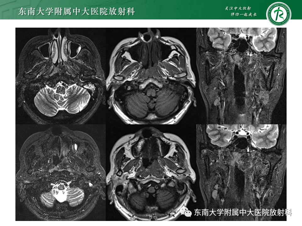 【PPT】鼻咽部占位性病变随访及鉴别-7