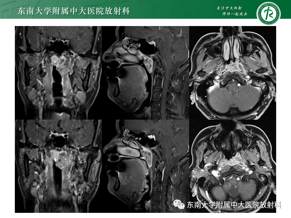 【PPT】鼻咽部占位性病变随访及鉴别-8