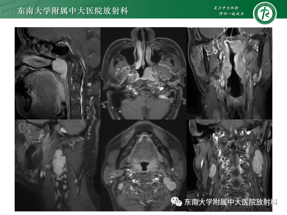 【PPT】鼻咽部占位性病变随访及鉴别-12