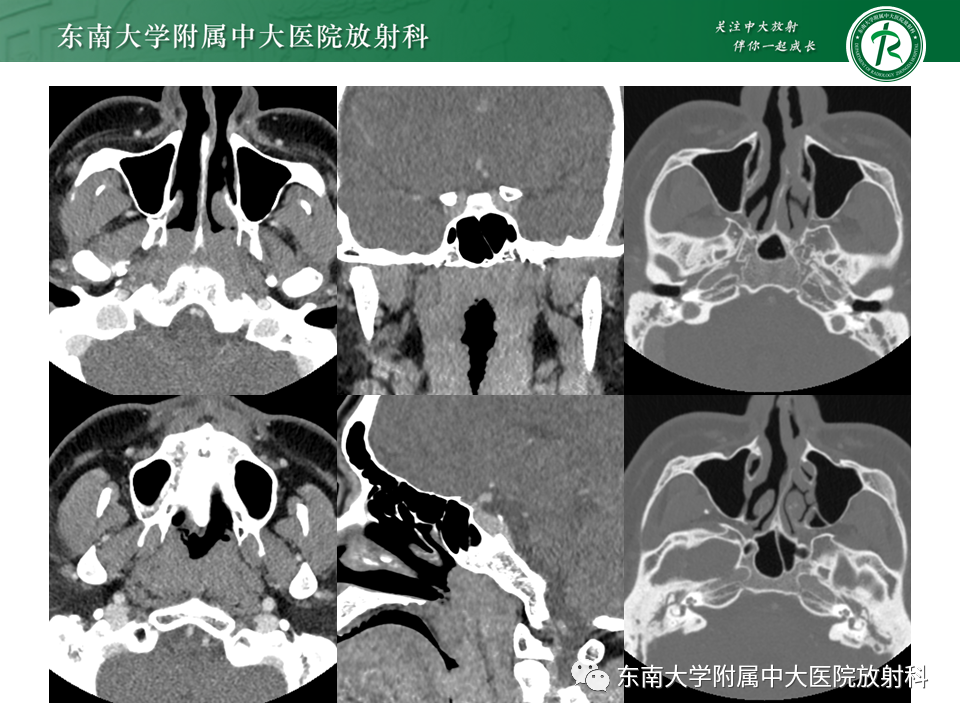 【PPT】鼻咽部占位性病变随访及鉴别-15