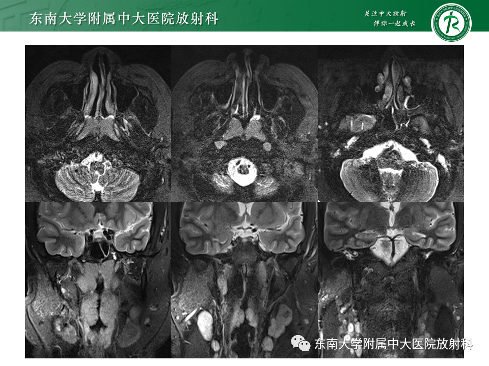 【PPT】鼻咽部占位性病变随访及鉴别-16