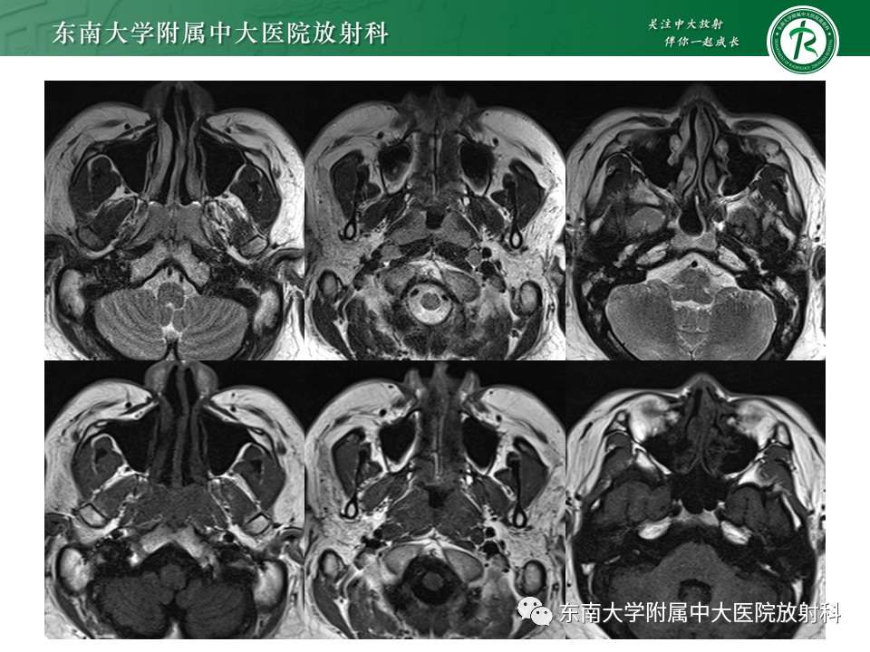 【PPT】鼻咽部占位性病变随访及鉴别-17